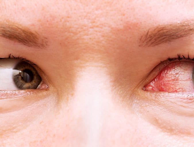 contact_lenses_eye_infections_row_1