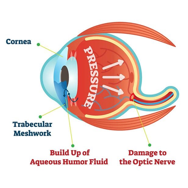 What_is_glaucoma_row_4