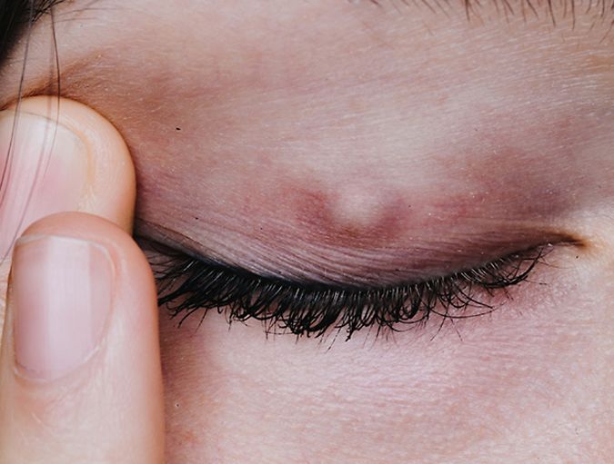 contact_lenses_and_chalazion_row_1