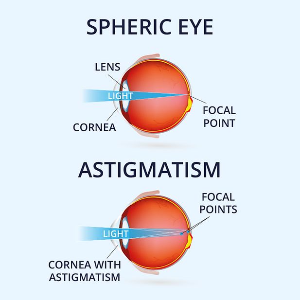 astigmatism_guide_row_3