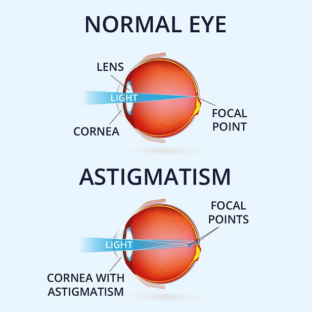 diagram of a standard eyeball compared with a diagram of an eyeball with astigmatism.